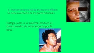 3. Trastorno funcional de tronco encefálico:
Se debe a afección de los pares craneales
Disfagia junto a la sialorrea produce el
clásico cuadro de echar espuma por la
boca
 