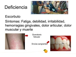 Deficiencia
Escorbuto
Síntomas: Fatiga, debilidad, irritabilidad,
hemorragias gingivales, dolor articular, dolor
muscular y muerte
Queratosis
folicular
Encías sangrantes
 