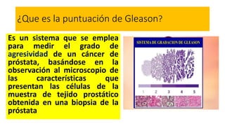 ¿Que es la puntuación de Gleason?
Es un sistema que se emplea
para medir el grado de
agresividad de un cáncer de
próstata, basándose en la
observación al microscopio de
las características que
presentan las células de la
muestra de tejido prostático
obtenida en una biopsia de la
próstata
 