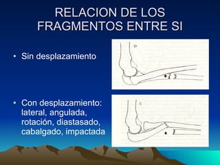 RELACION DE LOS FRAGMENTOS ENTRE SI Sin desplazamiento Con desplazamiento: lateral, angulada, rotación, diastasado, cabalgado, impactada 
