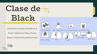 Las lesiones cariosas se dividen en 2:
Grupo 1: lesiones en fosas y fisuras
Grupo 2: lesiones de superficies lisas
Clase de
Black
 
