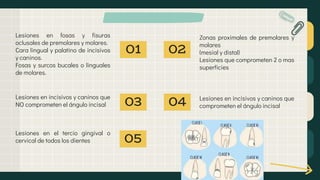01
Lesiones en fosas y fisuras
oclusales de premolares y molares.
Cara lingual y palatino de incisivos
y caninos.
Fosas y surcos bucales o linguales
de molares.
02
03 04
Zonas proximales de premolares y
molares
(mesial y distal)
Lesiones que comprometen 2 o mas
superficies
Lesiones en incisivos y caninos que
NO comprometen el ángulo incisal
Lesiones en incisivos y caninos que
comprometen el ángulo incisal
05
Lesiones en el tercio gingival o
cervical de todos los dientes
 