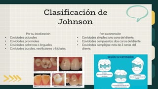 Clasificación de
Johnson
Por su localización
• Cavidades oclusales
• Cavidades proximales
• Cavidades palatinas o linguales
• Cavidades bucales, vestibulares o labiales.
Por su extensión
• Cavidades simples: una cara del diente.
• Cavidades compuestas: dos caras del diente
• Cavidades complejas: más de 2 caras del
diente.
 