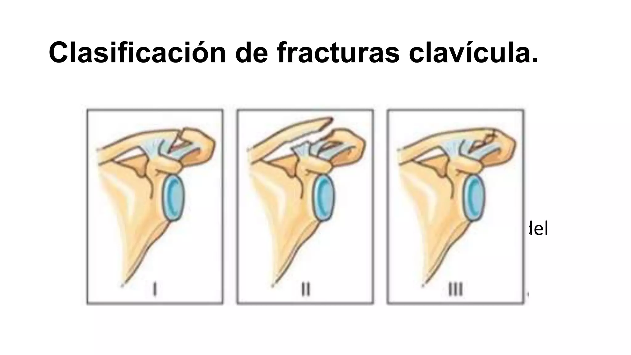 Clasificación de fracturas clavícula | PPTX