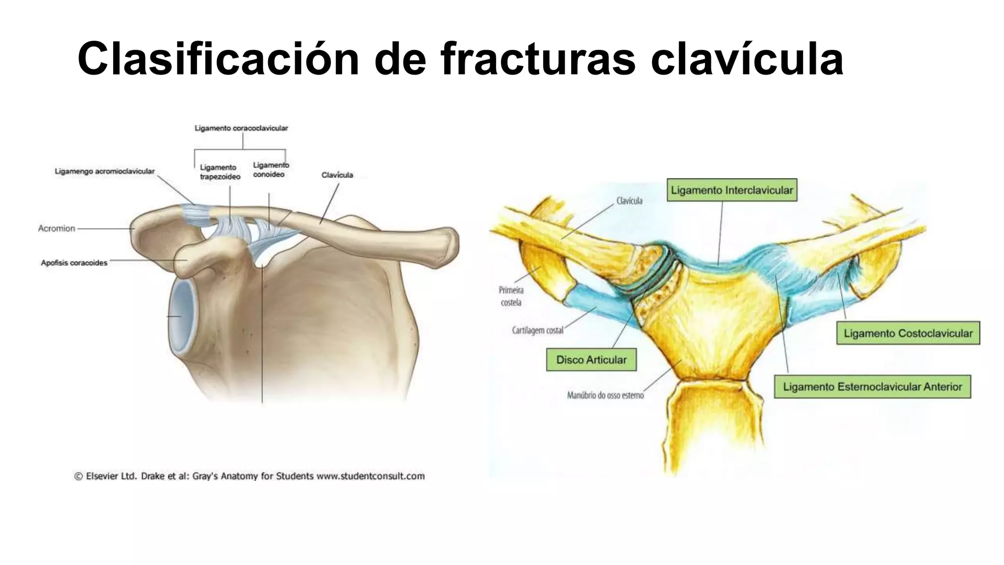 Clasificación de fracturas clavícula | PPTX