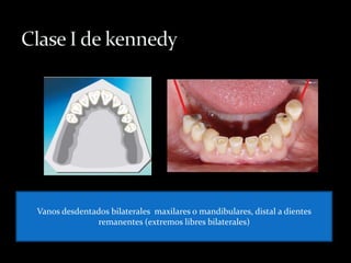 Vanos desdentados bilaterales maxilares o mandibulares, distal a dientes
remanentes (extremos libres bilaterales)
 