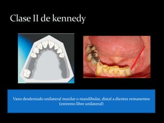 Vano desdentado unilateral maxilar o mandibular, distal a dientes remanentes
(extremo libre unilateral)
 