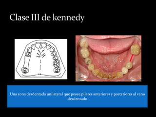 Una zona desdentada unilateral que posee pilares anteriores y posteriores al vano
desdentado
 