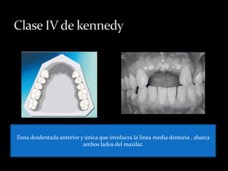 Zona desdentada anterior y única que involucra la línea media dentaria , abarca
ambos lados del maxilar.
 