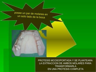 posee un par de molares en un solo lado de la boca PROTESIS MCOSOPORTADA Y SE PLANTEARA  LA EXTRACCION DE AMBOS MOLARES PA...