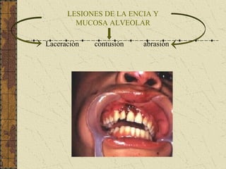 LESIONES DE LA ENCIA Y
MUCOSA ALVEOLAR
Laceración contusión abrasión
 