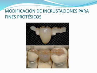 PREPARACIONES
INTRARRADICULARES
 Es un tipo de preparación que realizamos dentro de la
raíz del diente, se realiza para l...