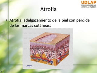 Atrofia
• Atrofia: adelgazamiento de la piel con pérdida
de las marcas cutáneas.
 