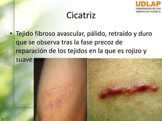 Cicatriz
• Tejido fibroso avascular, pálido, retraído y duro
que se observa tras la fase precoz de
reparación de los tejidos en la que es rojizo y
suave
 