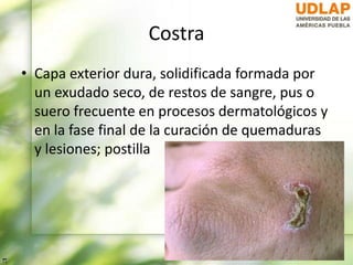 Costra
• Capa exterior dura, solidificada formada por
un exudado seco, de restos de sangre, pus o
suero frecuente en procesos dermatológicos y
en la fase final de la curación de quemaduras
y lesiones; postilla
 