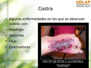 Costra
• Algunas enfermedades en las que se observan
costras son:
• Impétigo
• Seborrea
• Favo
• Quemaduras
 