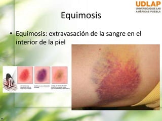 Equimosis
• Equimosis: extravasación de la sangre en el
interior de la piel
 