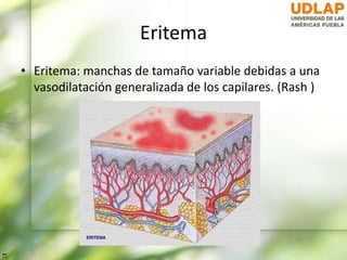 Eritema
• Eritema: manchas de tamaño variable debidas a una
vasodilatación generalizada de los capilares. (Rash )
 
