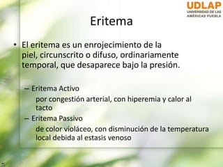 Eritema
• El eritema es un enrojecimiento de la
piel, circunscrito o difuso, ordinariamente
temporal, que desaparece bajo la presión.
– Eritema Activo
por congestión arterial, con hiperemia y calor al
tacto
– Eritema Passivo
de color violáceo, con disminución de la temperatura
local debida al estasis venoso
 