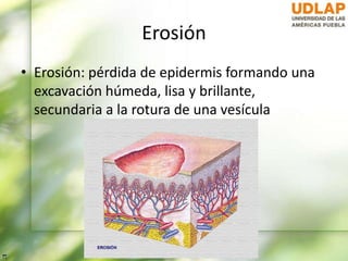 Erosión
• Erosión: pérdida de epidermis formando una
excavación húmeda, lisa y brillante,
secundaria a la rotura de una vesícula
 