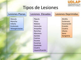 Tipos de Lesiones
Macula
Mancha
Infarto
Esclerosis
Telangiectasias
Pápula
Placa
Nódulo
Vesiculas
Ampollas
Ronchas
Abscesos
Quistes
Costras
Escaras
Escamas
Queloide
Cicatriz
Liquenificación
Atrofia
Esclerosis
Excoriación
Erosión
Cicatriz
Úlcera
Seno
Gangrena
Lesiones Planas Lesiones Elevadas Lesiones Deprimidas
 