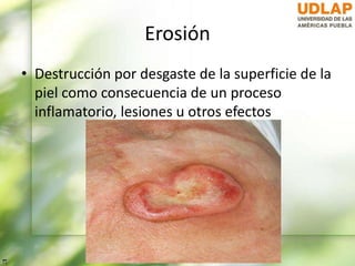 Erosión
• Destrucción por desgaste de la superficie de la
piel como consecuencia de un proceso
inflamatorio, lesiones u otros efectos
 