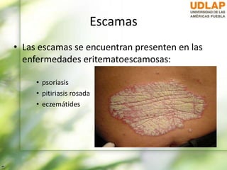Escamas
• Las escamas se encuentran presenten en las
enfermedades eritematoescamosas:
• psoriasis
• pitiriasis rosada
• eczemátides
 