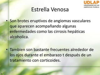 Estrella Venosa
• Son brotes eruptivos de angiomas vasculares
que aparecen acompañando algunas
enfermedades como las cirrosis hepáticas
alcoholica.
• Tambien son bastante frecuentes alrededor de
los ojos durante el embarazo t después de un
tratamiento con corticoides.
 