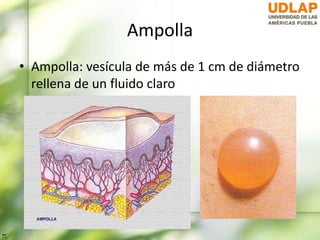 Ampolla
• Ampolla: vesícula de más de 1 cm de diámetro
rellena de un fluido claro
 