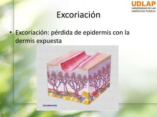 Excoriación
• Excoriación: pérdida de epidermis con la
dermis expuesta
 