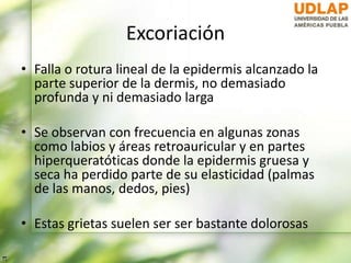 Excoriación
• Falla o rotura lineal de la epidermis alcanzado la
parte superior de la dermis, no demasiado
profunda y ni demasiado larga
• Se observan con frecuencia en algunas zonas
como labios y áreas retroauricular y en partes
hiperqueratóticas donde la epidermis gruesa y
seca ha perdido parte de su elasticidad (palmas
de las manos, dedos, pies)
• Estas grietas suelen ser ser bastante dolorosas
 