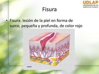 Fisura
• Fisura: lesión de la piel en forma de
surco, pequeña y profunda, de color rojo
 