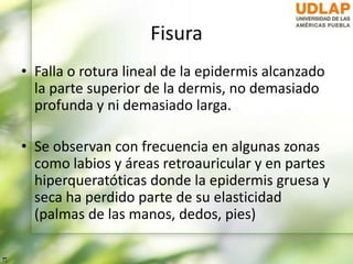 Fisura
• Falla o rotura lineal de la epidermis alcanzado
la parte superior de la dermis, no demasiado
profunda y ni demasiado larga.
• Se observan con frecuencia en algunas zonas
como labios y áreas retroauricular y en partes
hiperqueratóticas donde la epidermis gruesa y
seca ha perdido parte de su elasticidad
(palmas de las manos, dedos, pies)
 