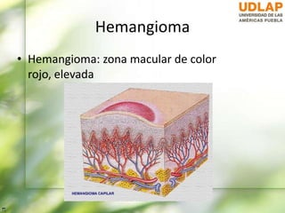 Hemangioma
• Hemangioma: zona macular de color
rojo, elevada
 