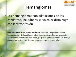 Hemangiomas
• Los hemangiomas son dilataciones de los
capilares subcutáneos, cuyo color disminuye
con la vitropresión
• Nevus flammeus del recién nacido: se cree que son proliferaciones
hamartomosas de las células endoteliales capilares. Es muy frecuente
apareciendo en la frente. raíz nasal, párpados y labio superior. Disminuye
progresivamente y casi siempre desaparece en el primer año.
 