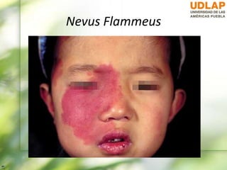 Nevus Flammeus
 