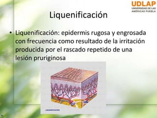 Liquenificación
• Liquenificación: epidermis rugosa y engrosada
con frecuencia como resultado de la irritación
producida por el rascado repetido de una
lesión pruriginosa
 