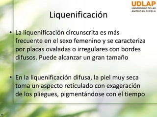 Liquenificación
• La liquenificación circunscrita es más
frecuente en el sexo femenino y se caracteriza
por placas ovaladas o irregulares con bordes
difusos. Puede alcanzar un gran tamaño
• En la liquenificación difusa, la piel muy seca
toma un aspecto reticulado con exageración
de los pliegues, pigmentándose con el tiempo
 