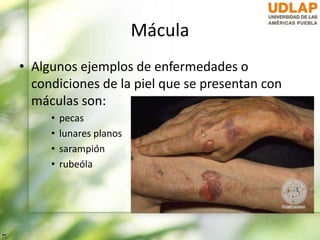 Mácula
• Algunos ejemplos de enfermedades o
condiciones de la piel que se presentan con
máculas son:
• pecas
• lunares planos
• sarampión
• rubeóla
 