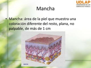 Mancha
• Mancha: área de la piel que muestra una
coloración diferente del resto, plana, no
palpable, de más de 1 cm
 