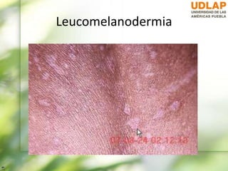 Leucomelanodermia
 
