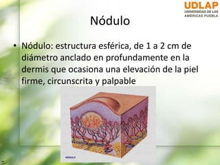 Nódulo
• Nódulo: estructura esférica, de 1 a 2 cm de
diámetro anclado en profundamente en la
dermis que ocasiona una elevación de la piel
firme, circunscrita y palpable
 
