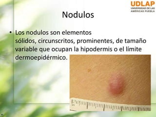 Nodulos
• Los nodulos son elementos
sólidos, circunscritos, prominentes, de tamaño
variable que ocupan la hipodermis o el límite
dermoepidérmico.
 