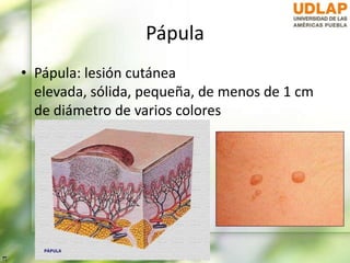 Pápula
• Pápula: lesión cutánea
elevada, sólida, pequeña, de menos de 1 cm
de diámetro de varios colores
 