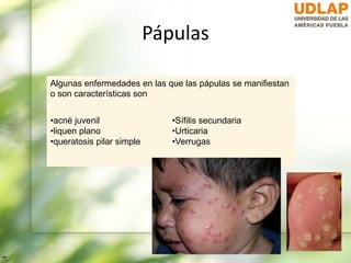 Pápulas
Algunas enfermedades en las que las pápulas se manifiestan
o son características son
•acné juvenil
•liquen plano
•queratosis pilar simple
•Sífilis secundaria
•Urticaria
•Verrugas
 