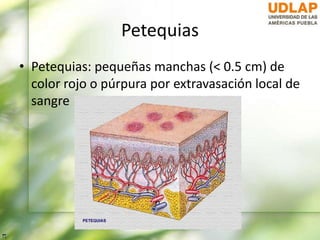 Petequias
• Petequias: pequeñas manchas (< 0.5 cm) de
color rojo o púrpura por extravasación local de
sangre
 