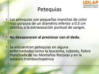 Petequias
• Las petequias son pequeñas manchas de color
rojo púrpura de un diamétro inferior a 0.5 cm
debidas a la extravasación puntual de sangre.
• No desaparecen al presionar con el dedo.
• Se encuentran petequias en alguna
enfermedades como la leucemia, rubeola, fiebre
manchada de las Montañas Rocosas y en la
púrpura trombocitopénica
 