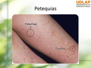 Petequias
 