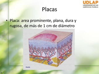 Placas
• Placa: area prominente, plana, dura y
rugosa, de más de 1 cm de diámetro
 