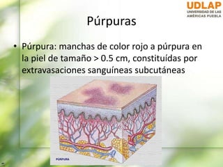 Púrpuras
• Púrpura: manchas de color rojo a púrpura en
la piel de tamaño > 0.5 cm, constituídas por
extravasaciones sanguíneas subcutáneas
 